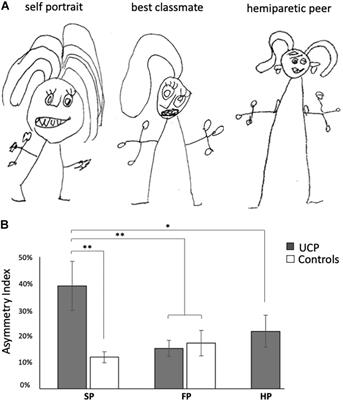 Body Representation in Children With Unilateral Cerebral Palsy